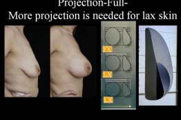 Breast Lift by Implant Alone Surgery