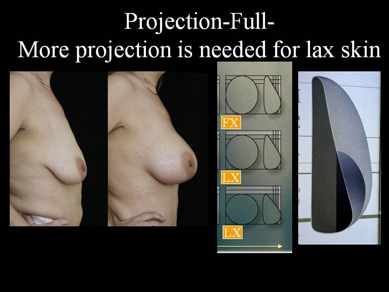 Breast Lift by Implant Alone Surgery