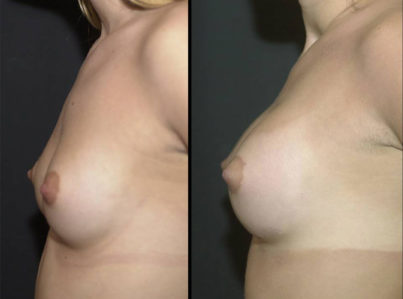 Breast Lift by Implant Alone Surgery