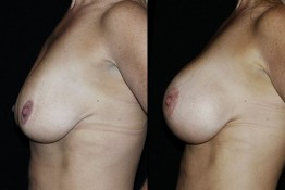 Breast Lift by Implant Alone Surgery