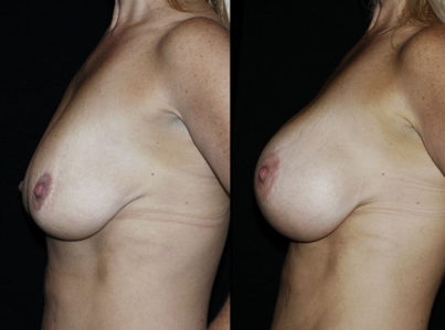 Breast Lift by Implant Alone Surgery