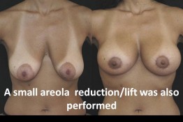 Breast Lift by Implant Alone Surgery