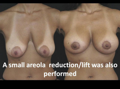 Breast Lift by Implant Alone Surgery