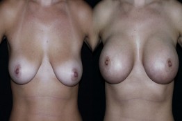 Breast Lift by Implant Alone Surgery