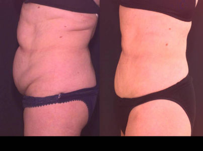 Abdomen Surgery