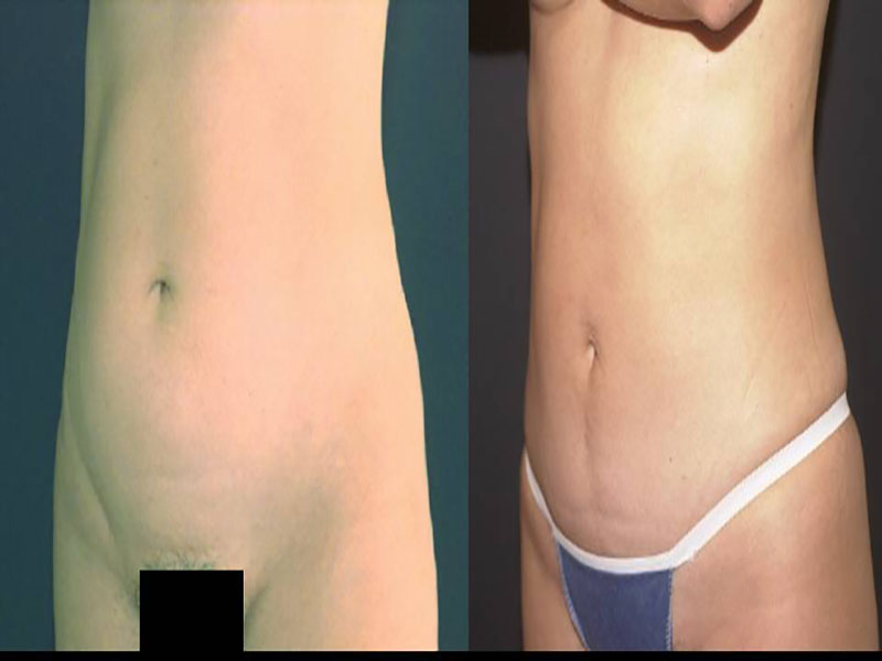 Abdomen Surgery