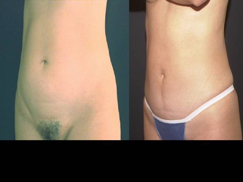 Abdomen Surgery