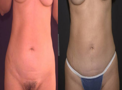 Abdomen Surgery