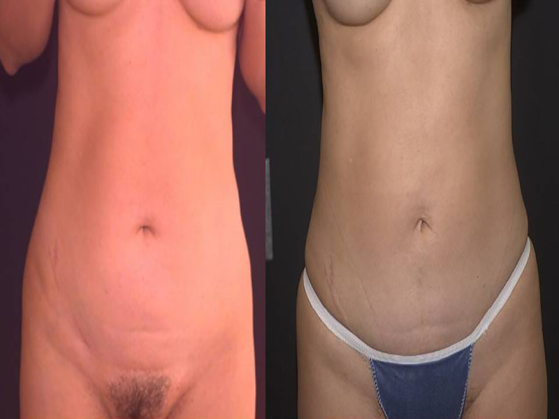 Abdomen Surgery