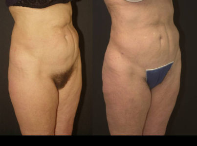 liposuction abdomen21