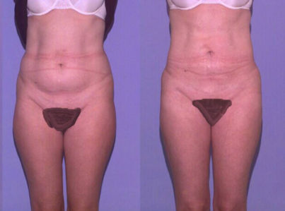 liposuction abdomen22