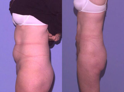 liposuction abdomen23