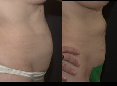 liposuction abdomen24