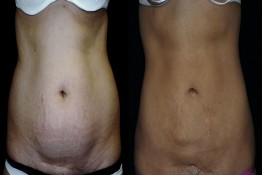 Abdomen Surgery