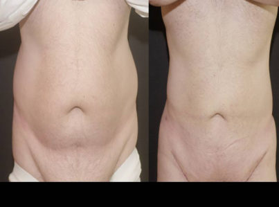 Abdomen Surgery