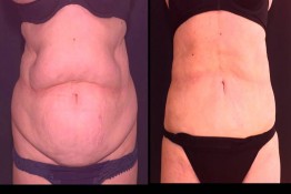 Abdomen Surgery