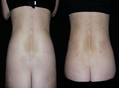 liposuction muffin top hips6