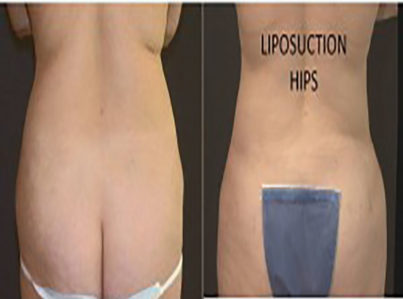 liposuction muffin top hips8