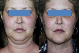 Liposuction Neck Surgery