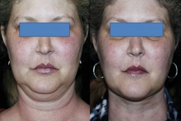 Liposuction Neck Surgery