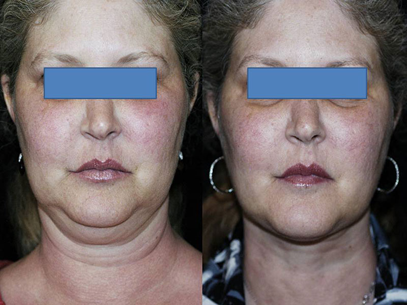 Liposuction Neck Surgery