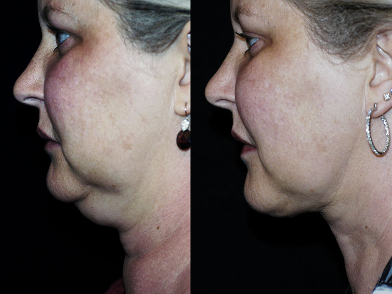 Liposuction Neck Surgery