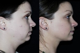 Liposuction Neck Surgery