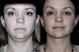 Liposuction Neck Surgery