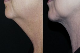 Liposuction Neck Surgery