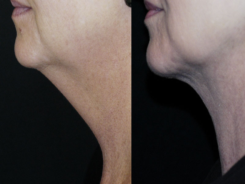 Liposuction Neck Surgery