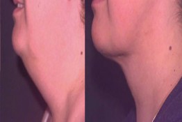 Liposuction Neck Surgery