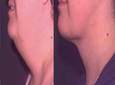 Liposuction Neck Surgery