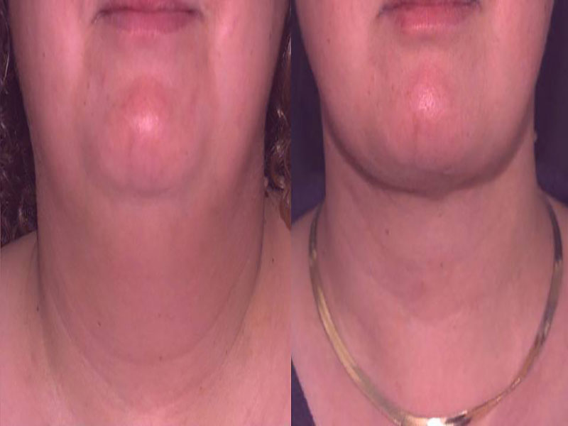 Liposuction Neck Surgery