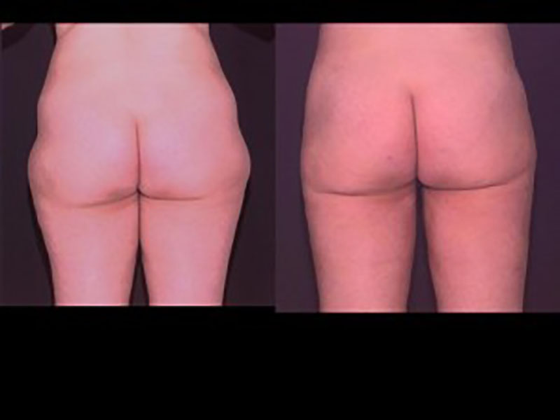 Lateral thigh Saddle bags Surgery