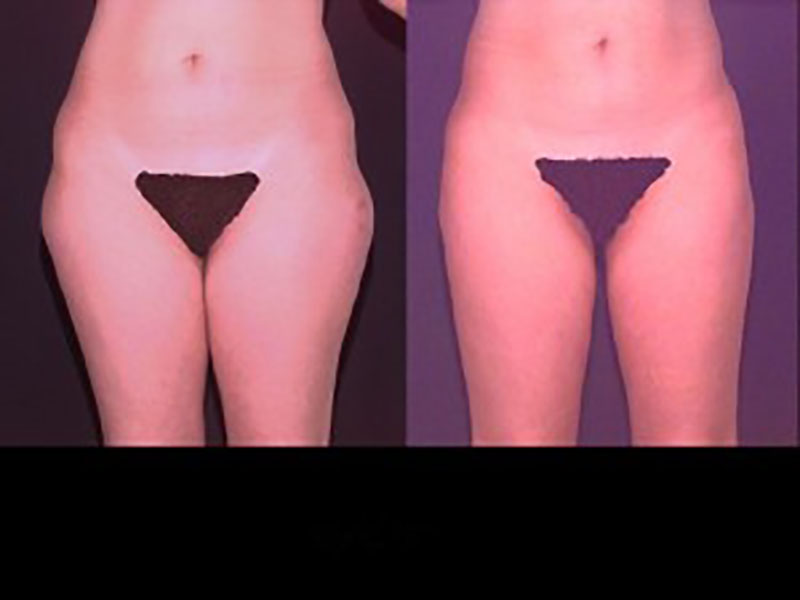 Lateral thigh Saddle bags Surgery