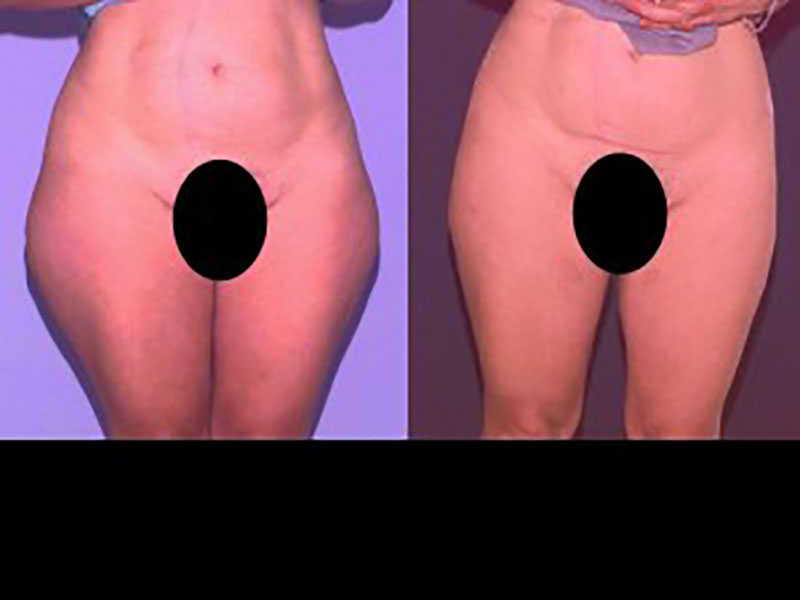 Lateral thigh Saddle bags Surgery