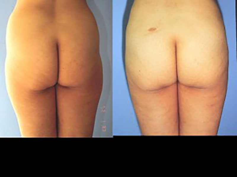 Lateral thigh Saddle bags Surgery
