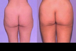 Lateral thigh Saddle bags Surgery