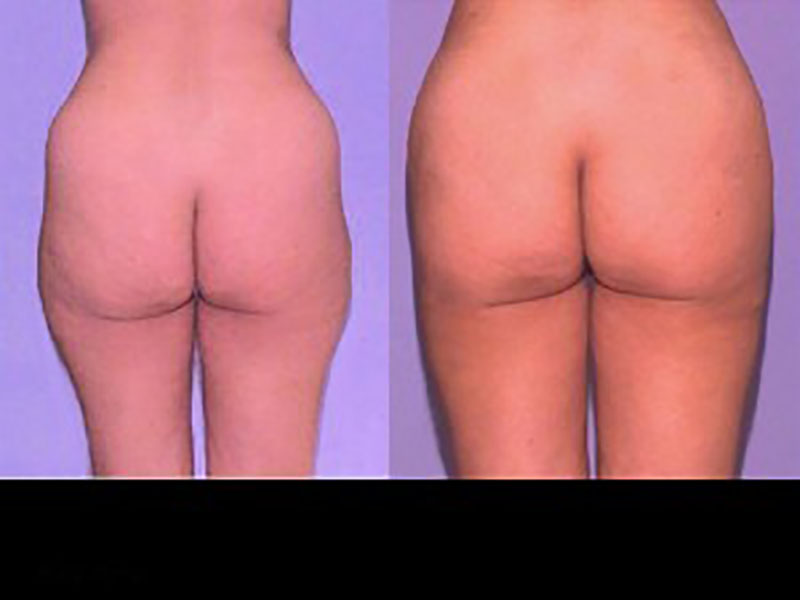 Lateral thigh Saddle bags Surgery