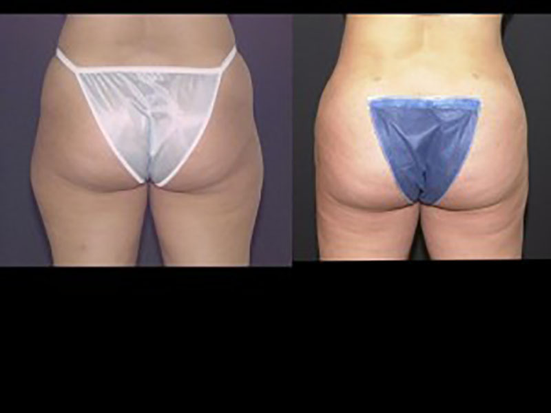 Lateral thigh Saddle bags Surgery