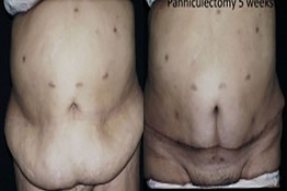 Body Contouring After Major Weight Loss Surgery