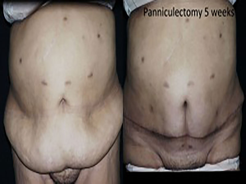 Body Contouring After Major Weight Loss Surgery