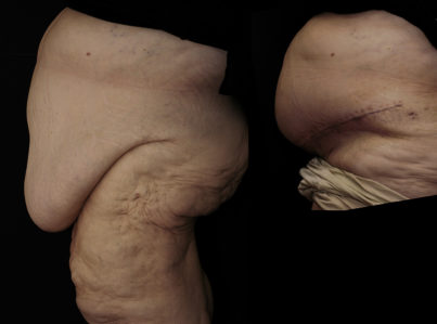 Body Contouring After Major Weight Loss Surgery