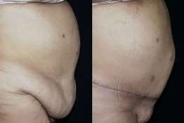 Body Contouring After Major Weight Loss Surgery