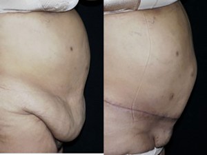 Body Contouring After Major Weight Loss Surgery