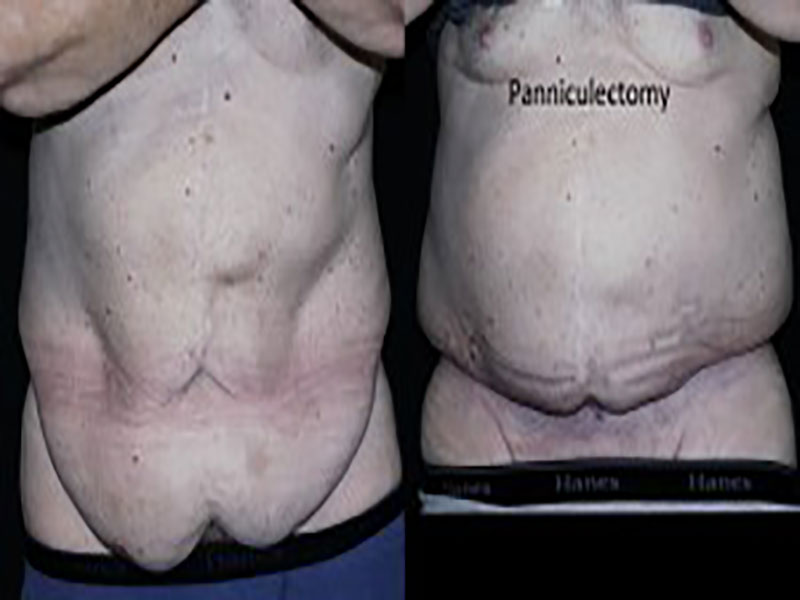 Body Contouring After Major Weight Loss Surgery