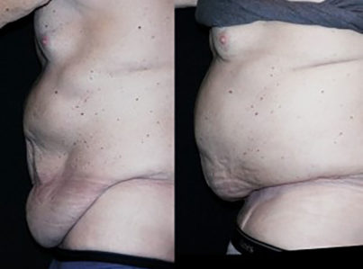 Body Contouring After Major Weight Loss Surgery