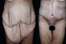 Body Contouring After Major Weight Loss Surgery