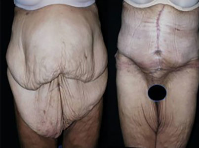 Body Contouring After Major Weight Loss Surgery