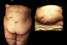 Body Contouring After Major Weight Loss Surgery